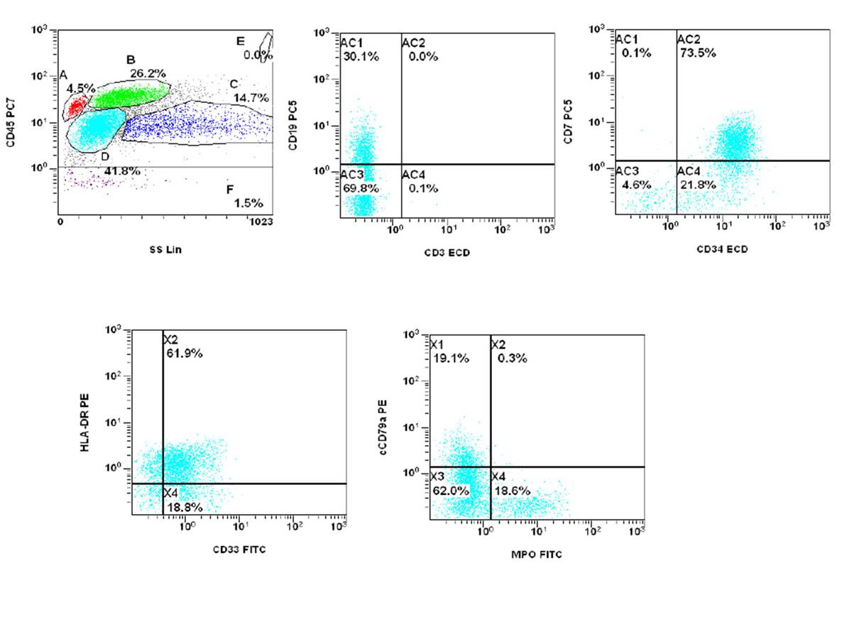 There are increase blasts (42%) that are positive for CD19 (partial), CD34, CD7, CD33 (dim), HLA-DR (dim), MPO (partial), and cCD79a (partial).
